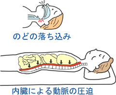 鶴の夢M 仰向け寝のリスク